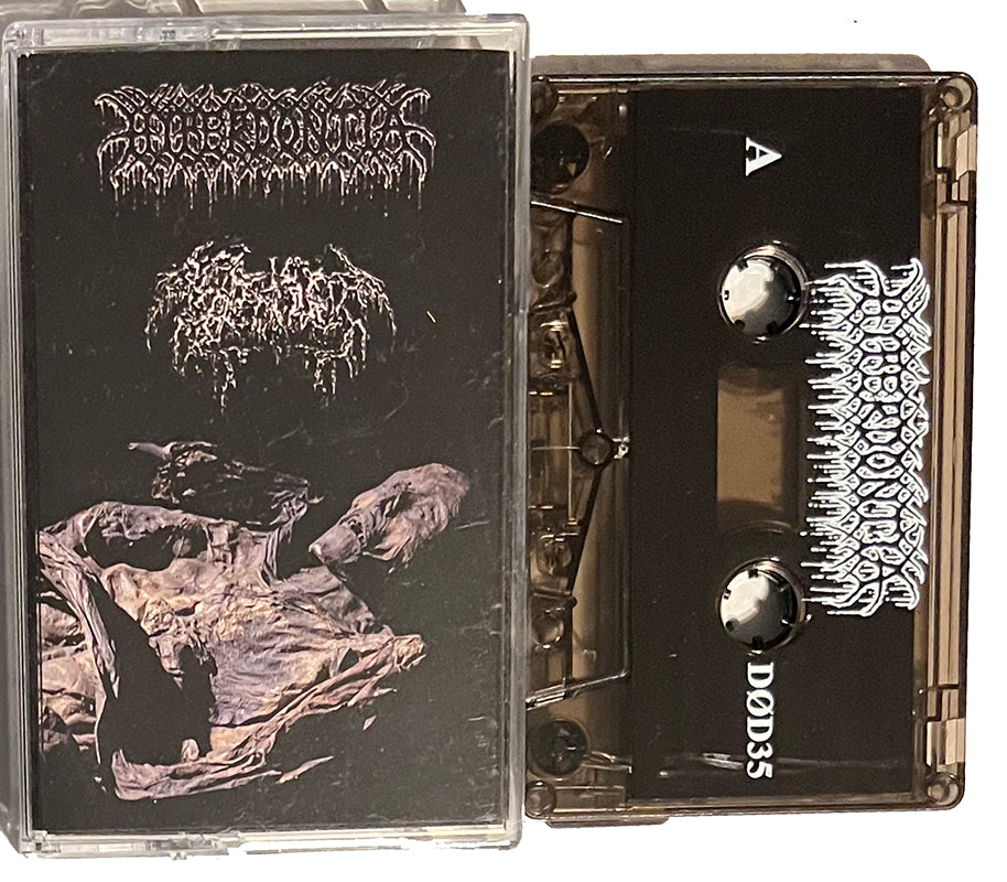 Hyperdontia Septage Cassette split Tape