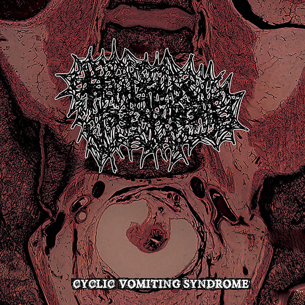 Foetal Fluids To Expurgate "Cyclic Vomiting Syndrome" CD